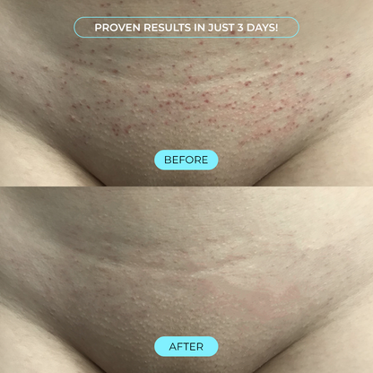 BikiniBumpz™ Ingrown Hair Serum